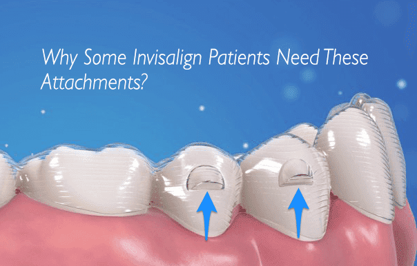 Advanced Orthodontic Innovation: Exploring Invisalign Attachments, by  Dentalsavitha