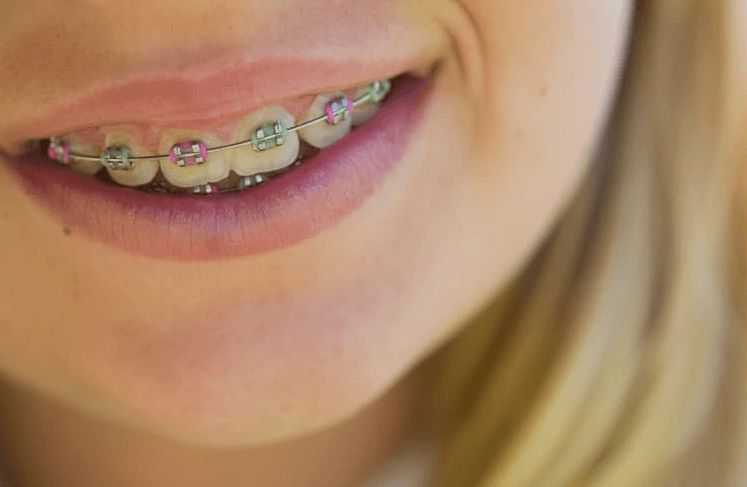 clear braces with purple bands