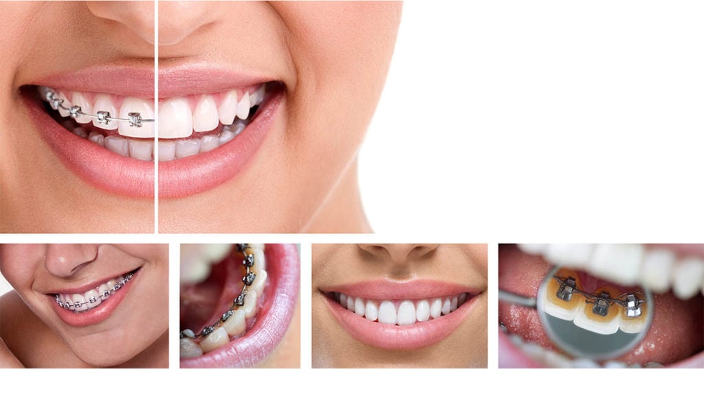 dental braces - lingual braces, before and after