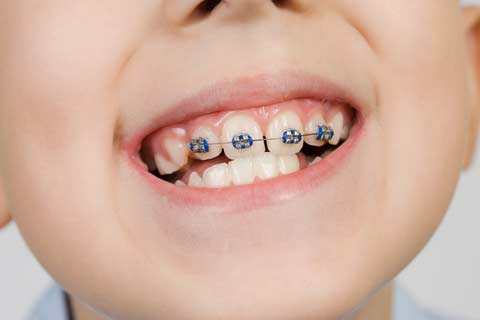 Early Orthodontic Treatment