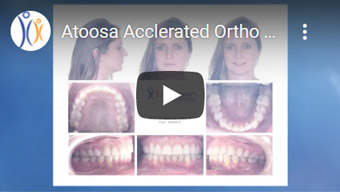 Image of Atoosa Acclerated Ortho Treatment Click to See Video
