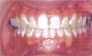 Image of Improper Brushing and Flossing
