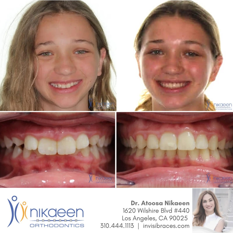 Image of before and after patient 5