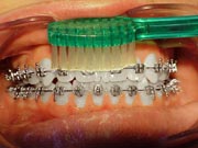 Image of Brush Teeth with Braces