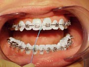Image of floss between braces