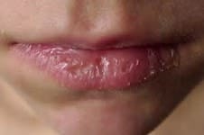 Chapped lips