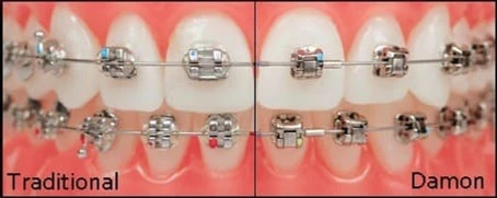 traditional vs damon braces