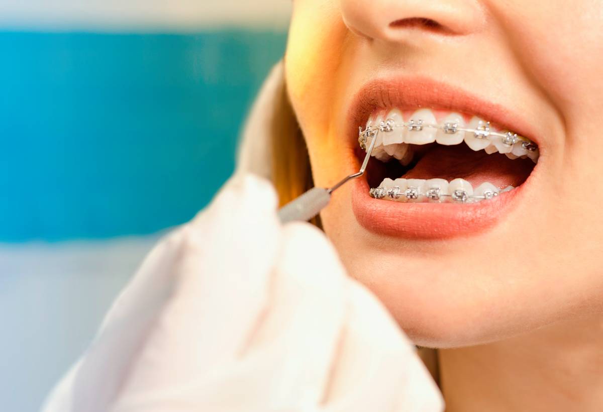 Female patient getting braces as an adult