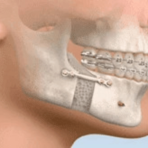 orthognatic surgery