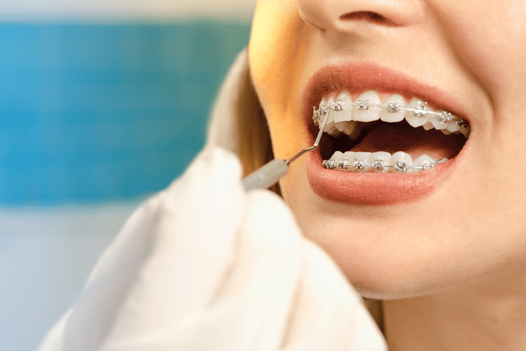 Invisalign aligners Westwood