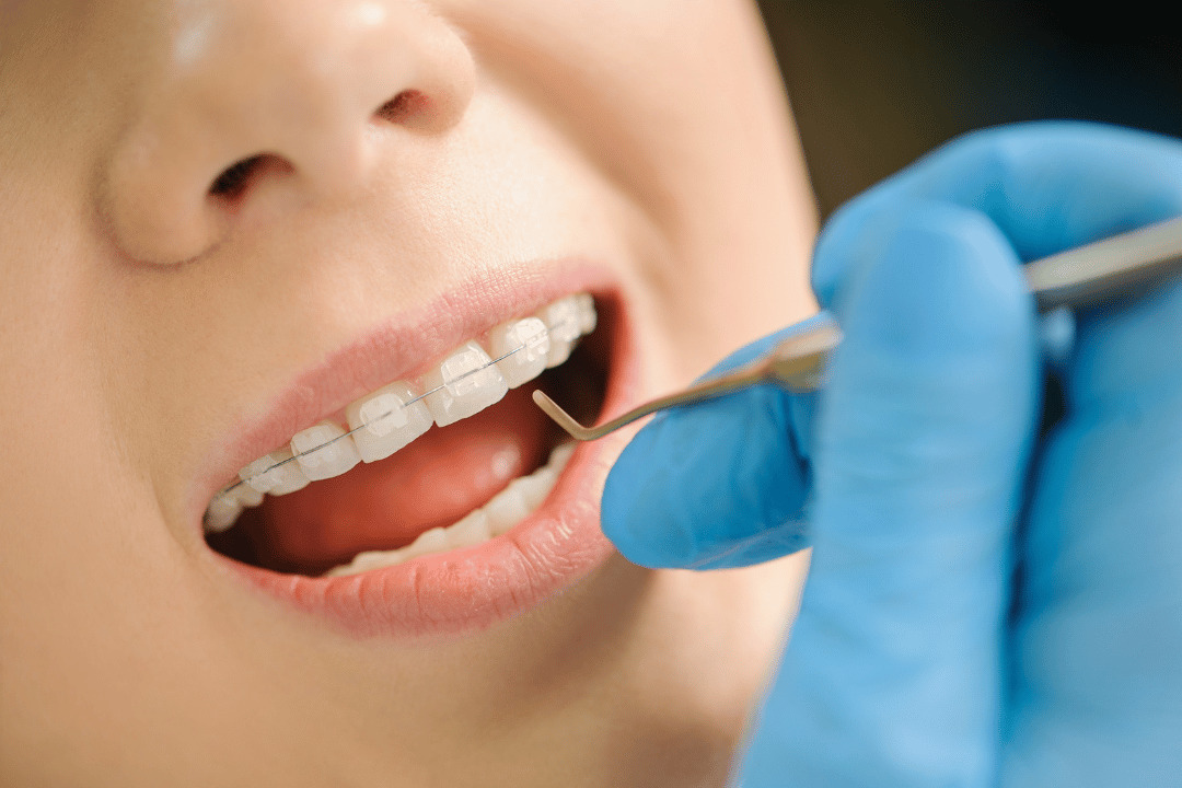 clear aligners consultation LA