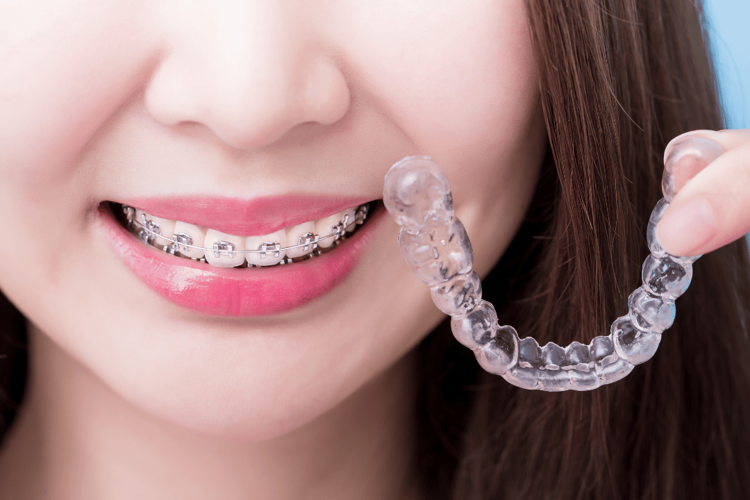 invisible aligners for professionals