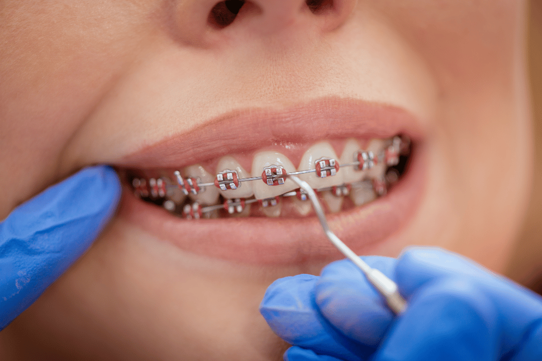 self ligating braces close up