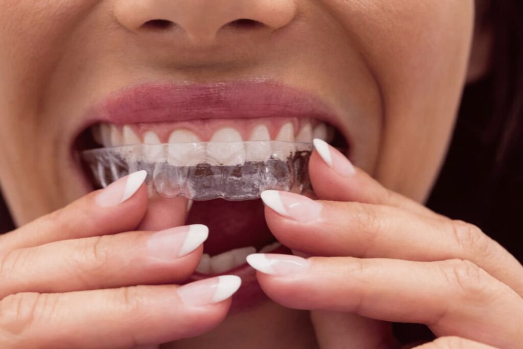 before after invisalign treatment
