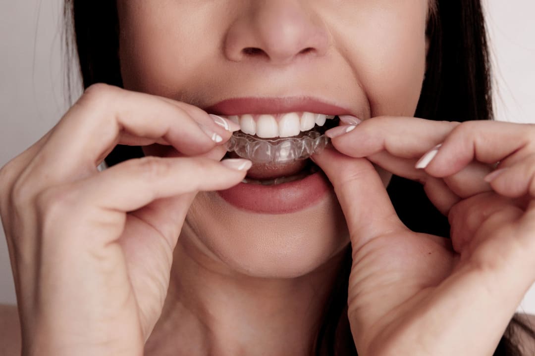 invisalign los angeles