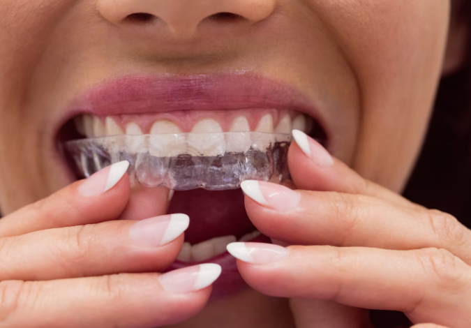 Los Angeles Invisalign