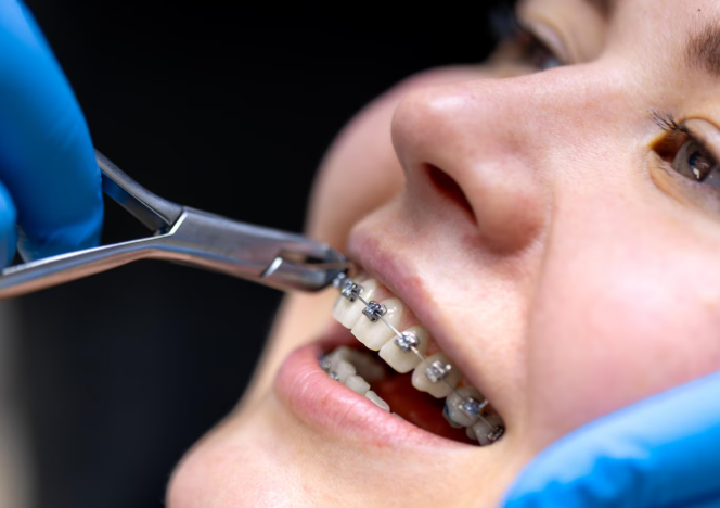 ceramic braces Los Angeles