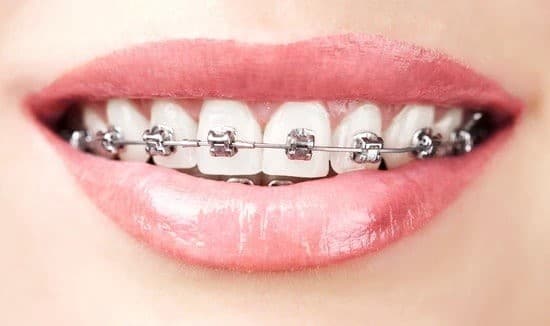 dental braces los angeles​