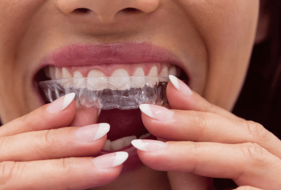 invisalign in culver city