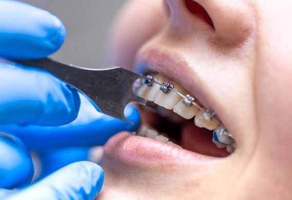 Braces in Los Angeles