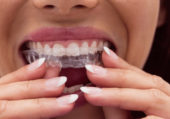 invisalign in west hollywood​