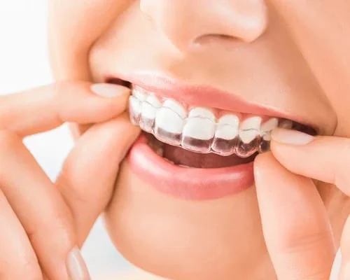 Invisalign