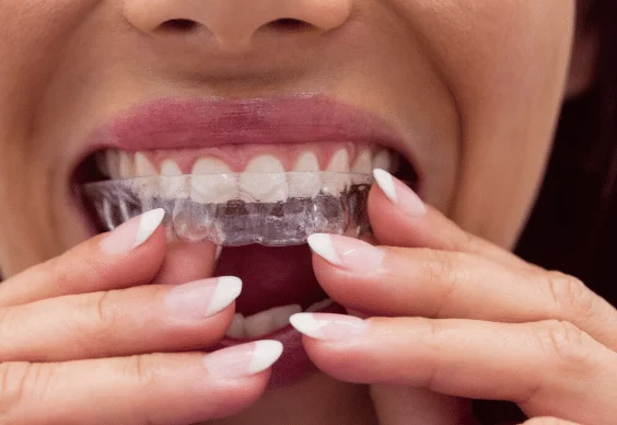 Invisalign in West Hollywood